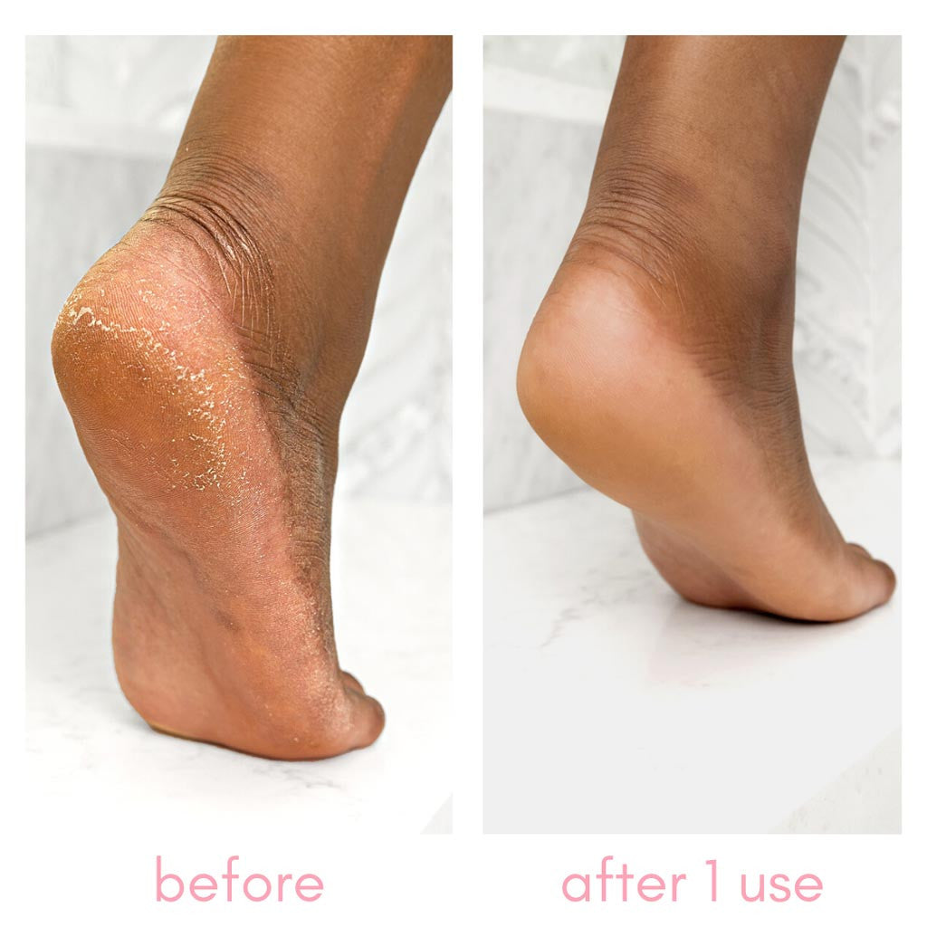 The Heel-ing Callus Remover Kit Diamond Nail Supplies