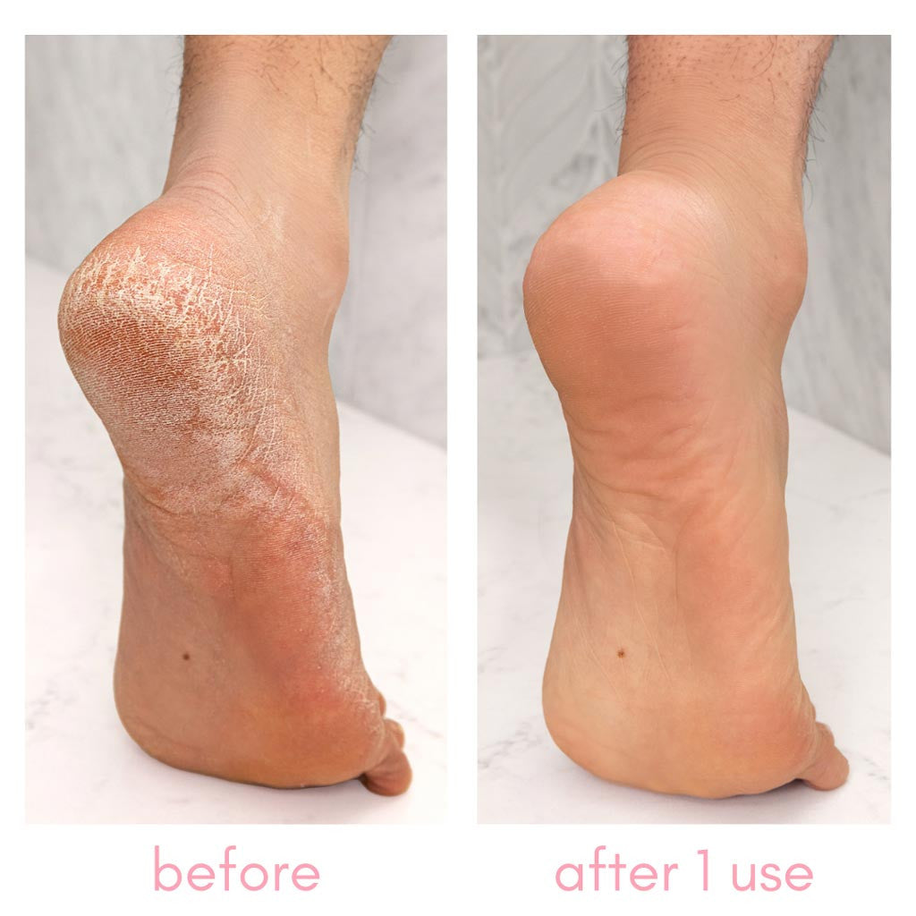 The Heel-ing Callus Remover Kit Diamond Nail Supplies