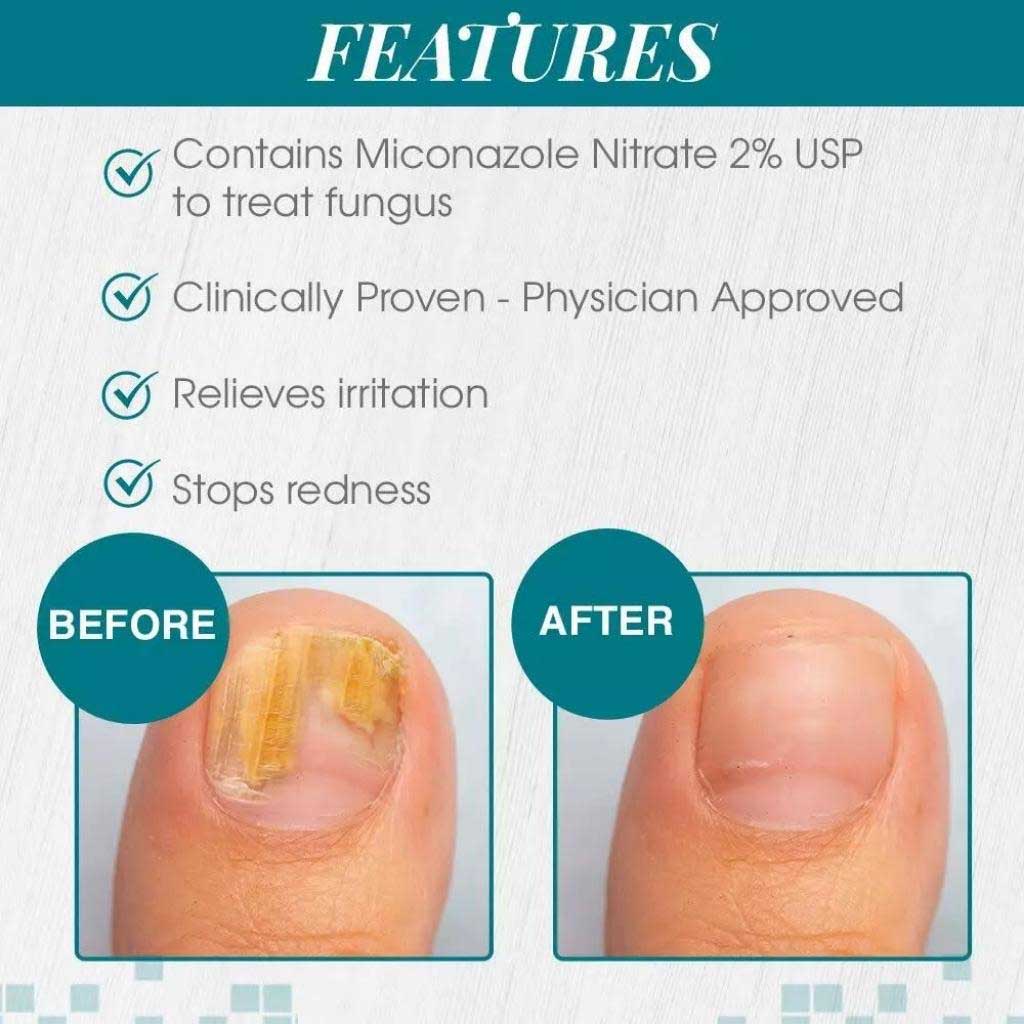 Antifungal - Maximum Strength