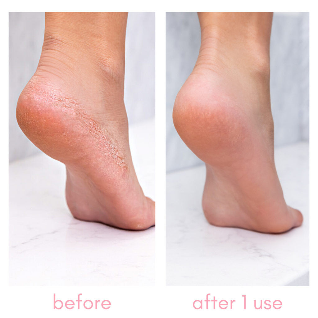The Heel-ing Callus Remover Kit Diamond Nail Supplies